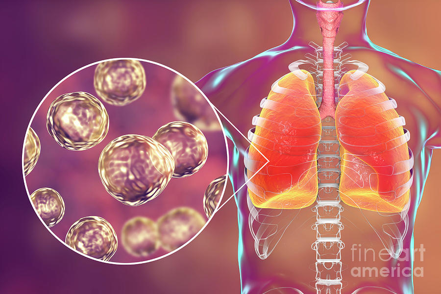 Pulmonary Blastomycosis Photograph by Kateryna Kon/science Photo ...