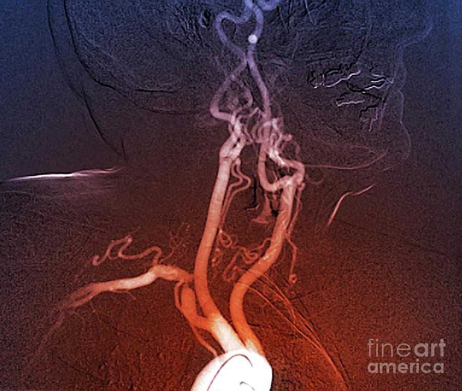 Atherosclerosis Photograph - Reduced Blood Flow In Polyvascular Disease #2 by Zephyr/science Photo Library