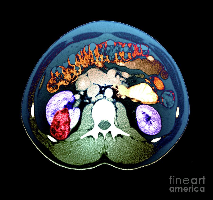 Renal Cancer #2 Photograph by Zephyr/science Photo Library