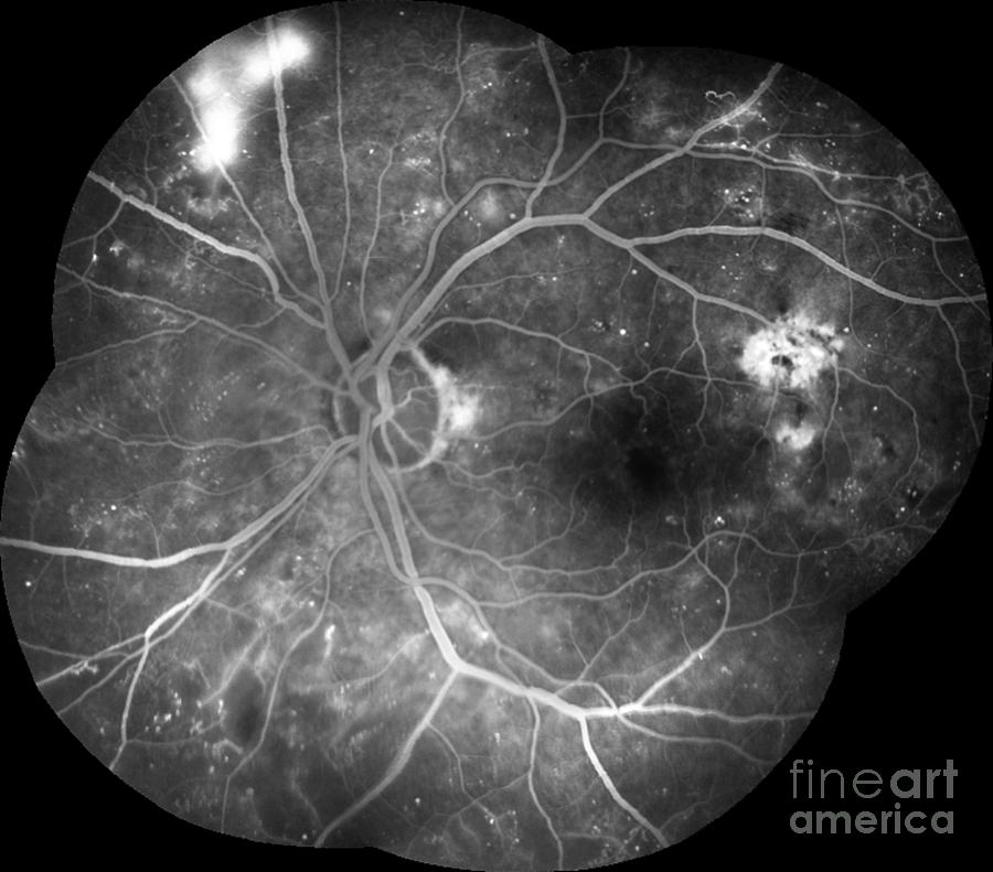 Retina Damage From Diabetes #2 Photograph by Alan Frohlichstein/science Photo Library