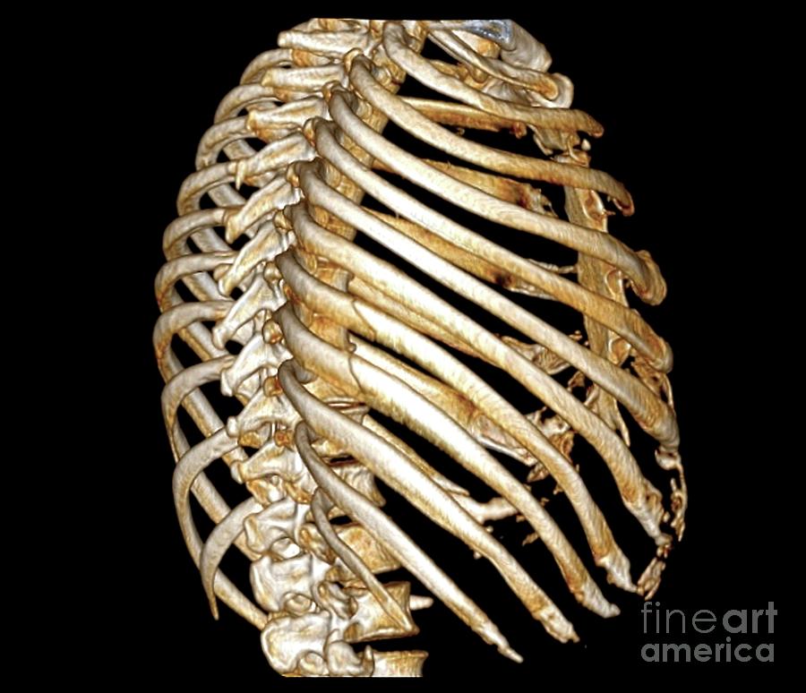 Disease Photograph - Rib Fractures by Zephyr/science Photo Library Disease Photograph - Rib Fractures by Zephyr/science Photo Library