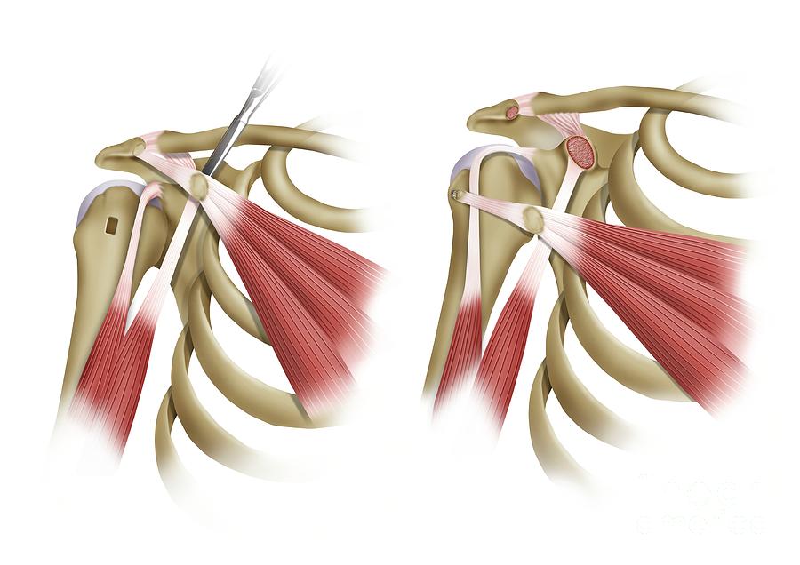 Shoulder Muscles Surgery Photograph by Maurizio De Angelis/science ...