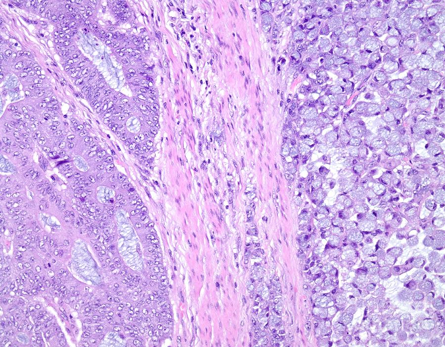 Signet Ring Cell Carcinoma Of The Colon Photograph by Webpathology ...