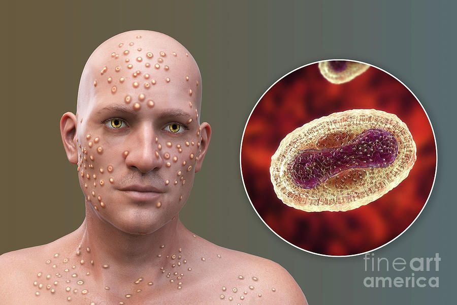 Smallpox Virus Infection 2 Photograph By Kateryna Kon science Photo 