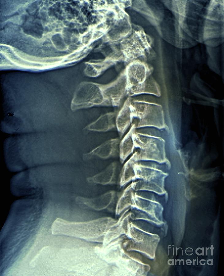 Spinal Arthritis Photograph By Zephyr Science Photo Library Pixels