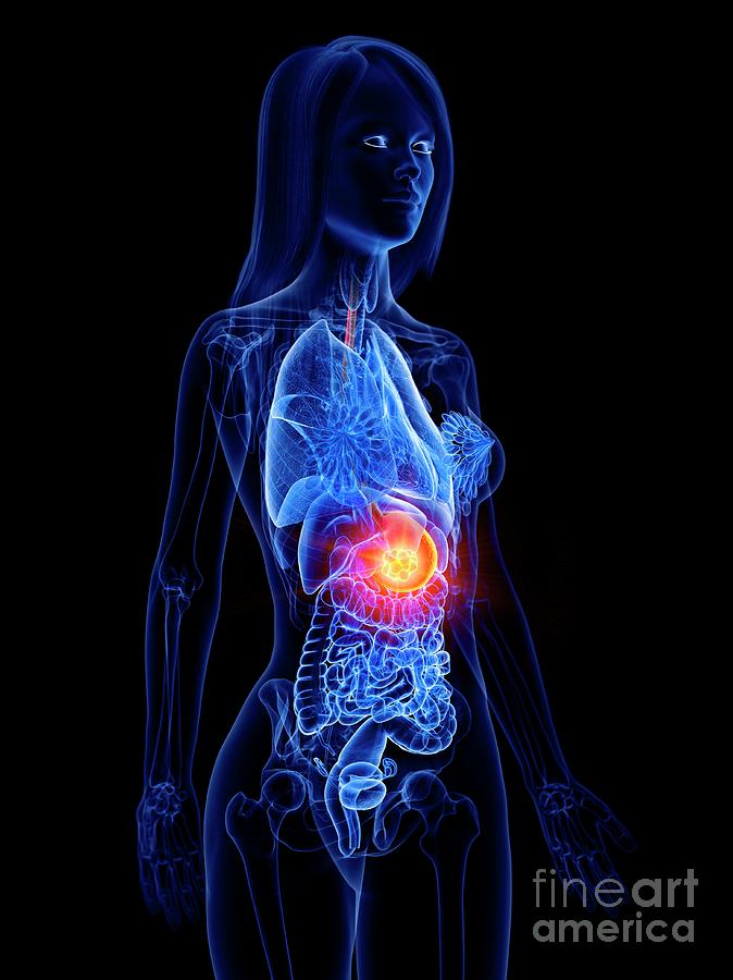 3d Photograph - Stomach Cancer #2 by Sebastian Kaulitzki/science Photo Library