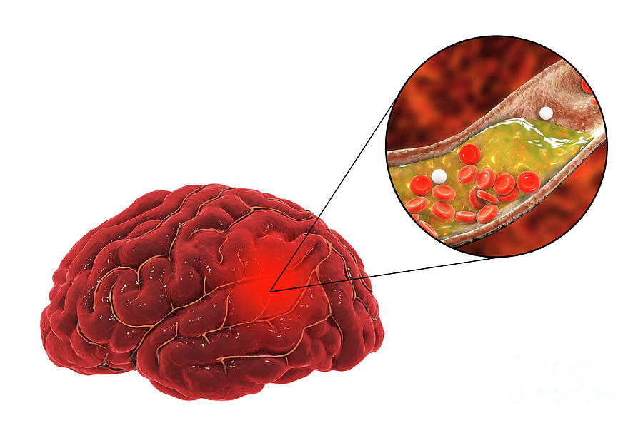 Schlaganfall. Rat model of ischemic stroke.