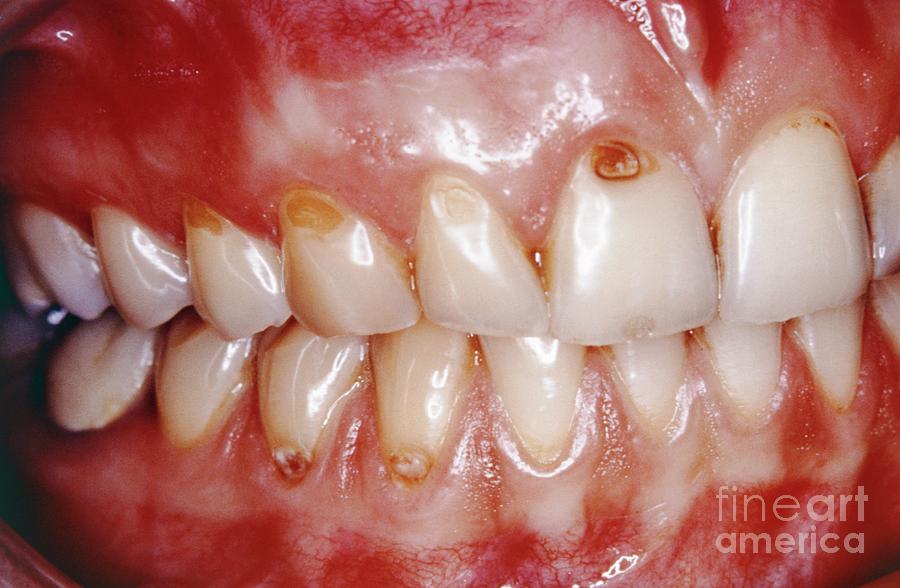 Tooth Decay #2 Photograph by Cnri/science Photo Library