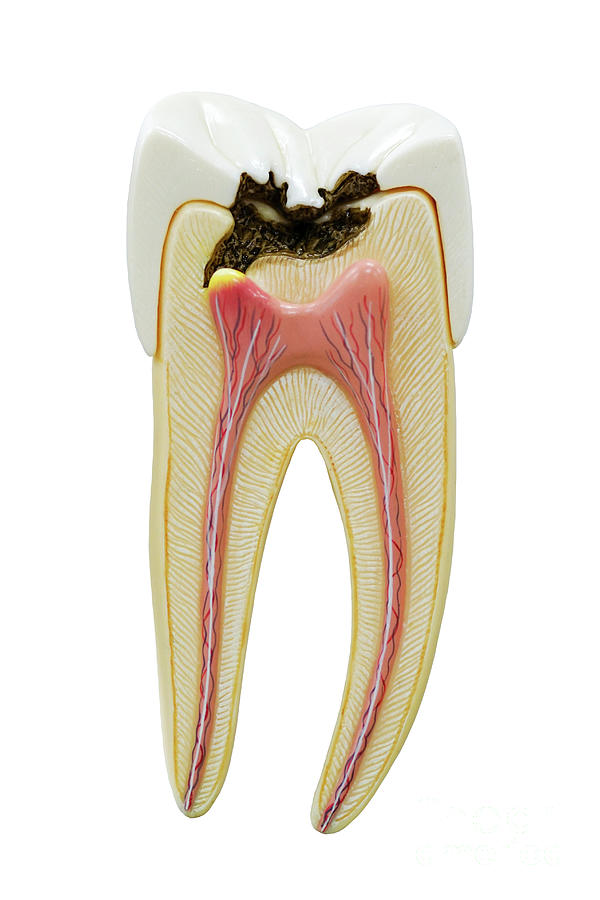 Tooth Decay Model #2 Photograph by Choksawatdikorn / Science Photo Library