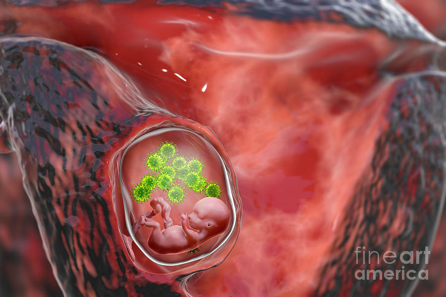 Transplacental Transmission Of Cytomegalovirus #2 by Science Photo Library