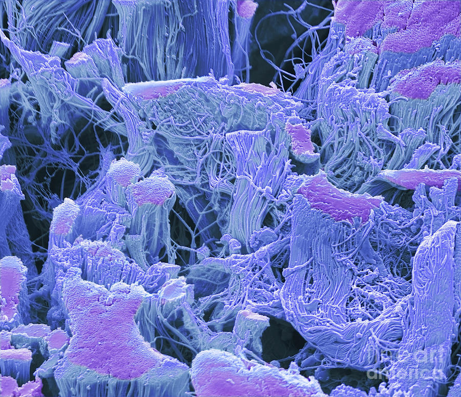 Tumour Connective Tissue #2 Photograph by Steve Gschmeissner/science Photo Library