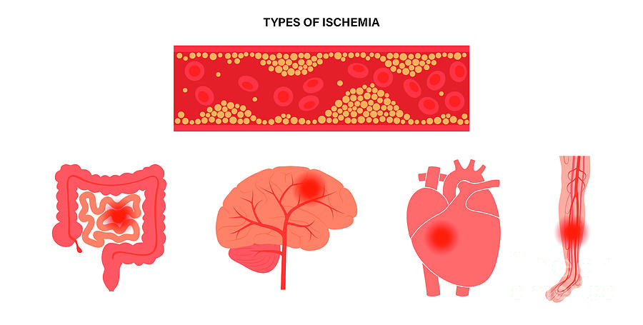 Types Of Ischaemic Photograph by Pikovit / Science Photo Library | Pixels