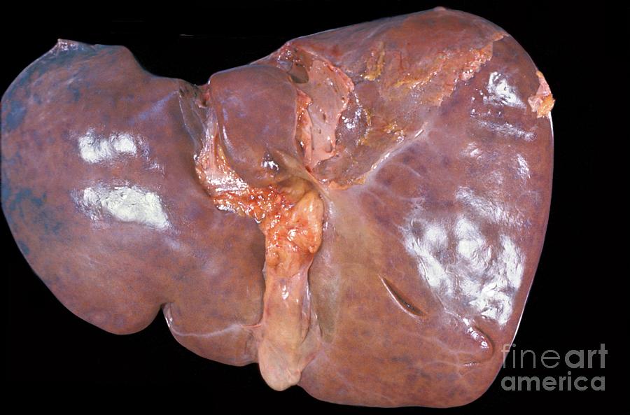Unhealthy Human Liver #2 Photograph by Jose Calvo / Science Photo Library