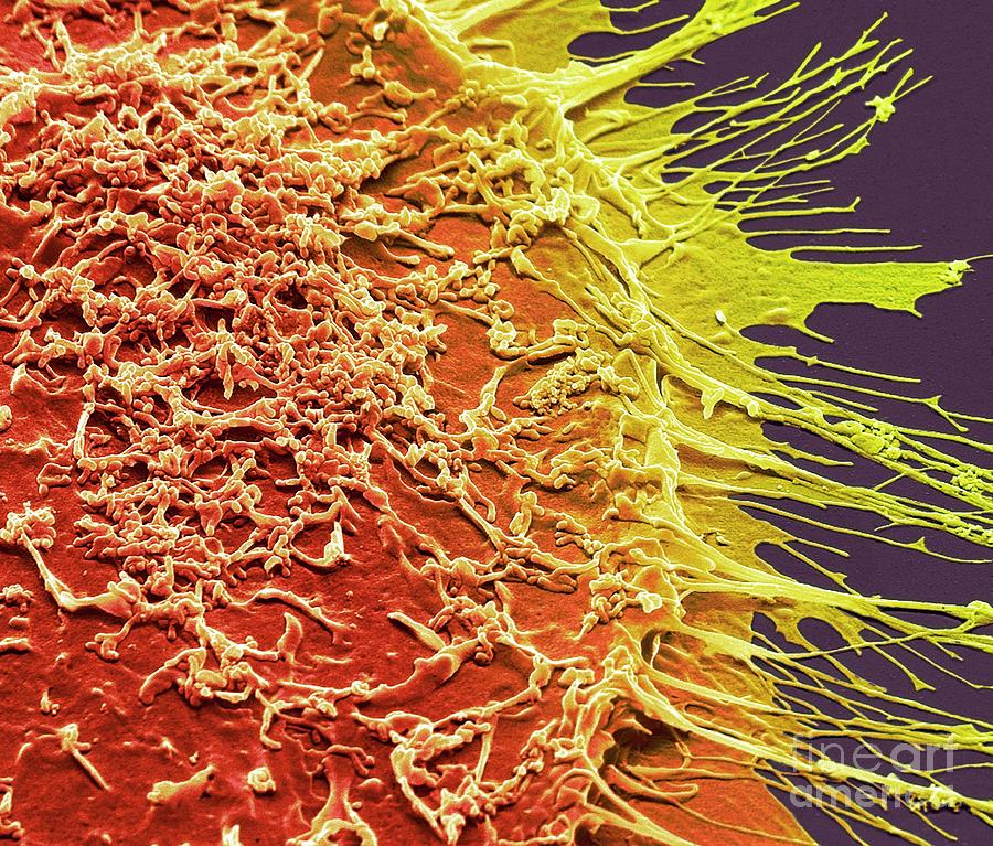 Vaginal Cancer Cells #2 Photograph by Steve Gschmeissner/science Photo Library