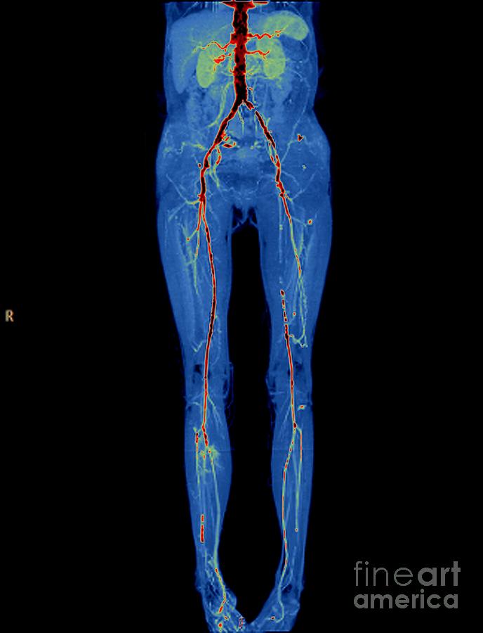 Vascular Disease Photograph By Zephyr/science Photo Library