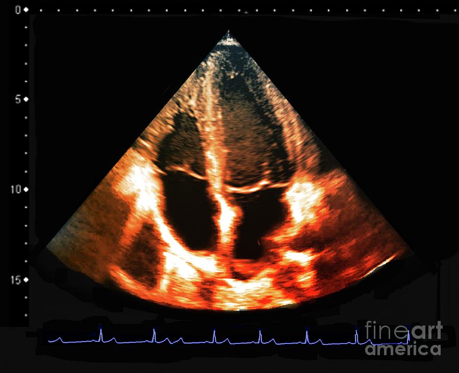 Ventricular Enlargement #2 Photograph by Zephyr/science Photo Library