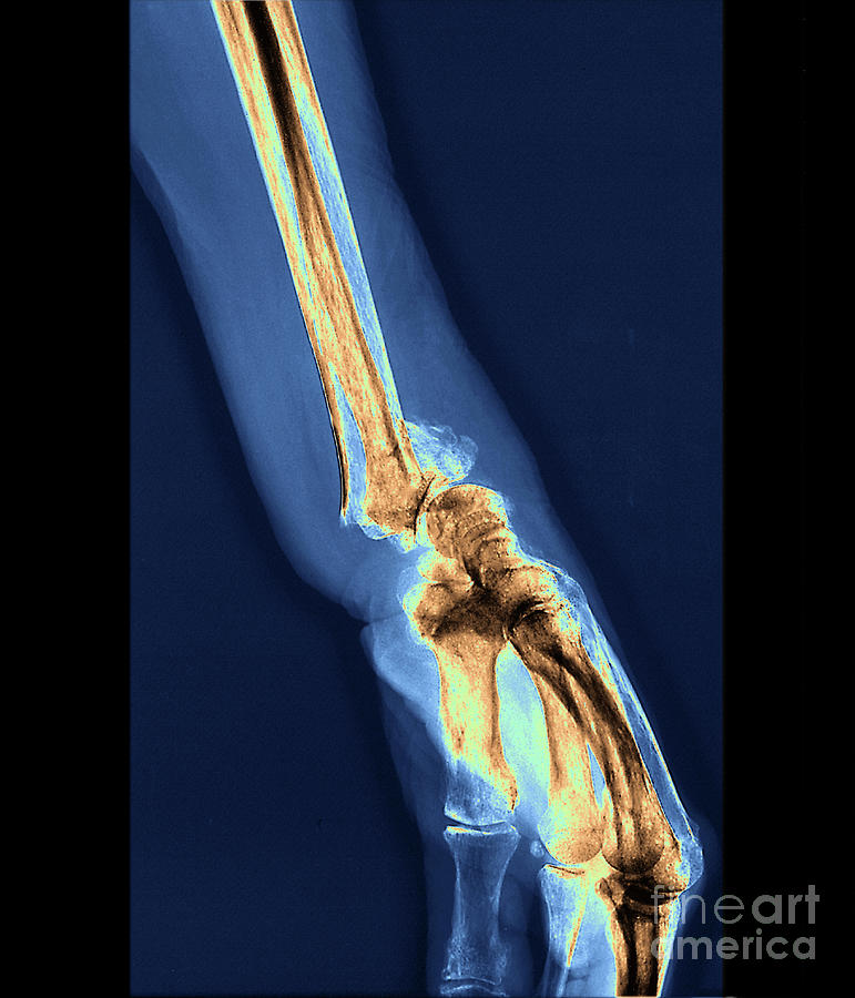 Wrist Fracture Photograph By Zephyrscience Photo Library Fine Art America 8531