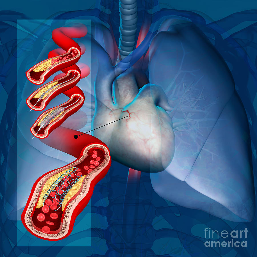 Angioplasty With Stent Placement Photograph By Fernando Da Cunhascience Photo Library Pixels 9356