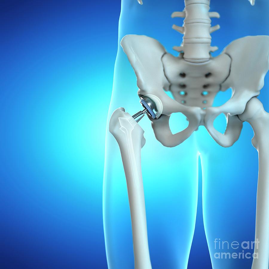 Hip Replacement Photograph By Sebastian Kaulitzki Science Photo Library