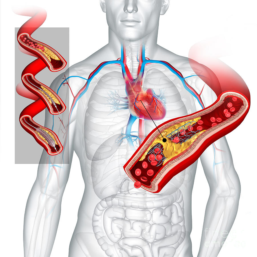 Angioplasty With Stent Placement Photograph by Fernando Da Cunha ...