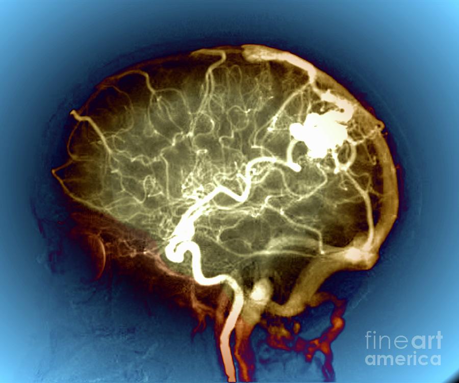 Cerebral Arteriovenous Malformation #21 Photograph by Zephyr/science Photo Library