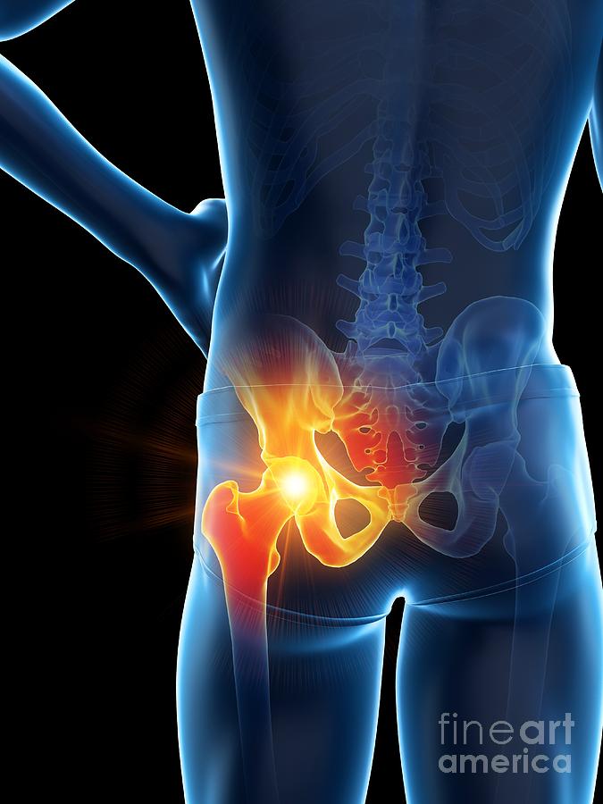 Hip Pain #21 Photograph by Sebastian Kaulitzki/science Photo Library