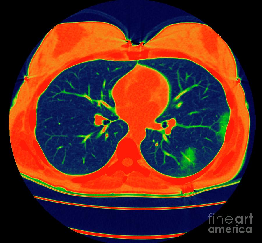 Lungs Affected By Covid-19 Pneumonia #21 Photograph by Vsevolod Zviryk ...