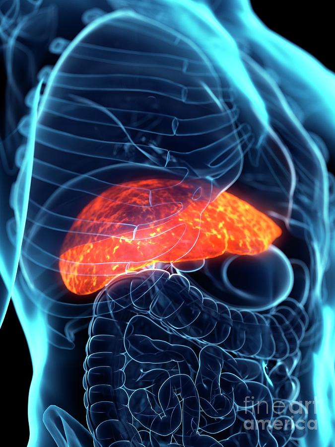 Diseased Liver Photograph by Sebastian Kaulitzki/science Photo Library ...