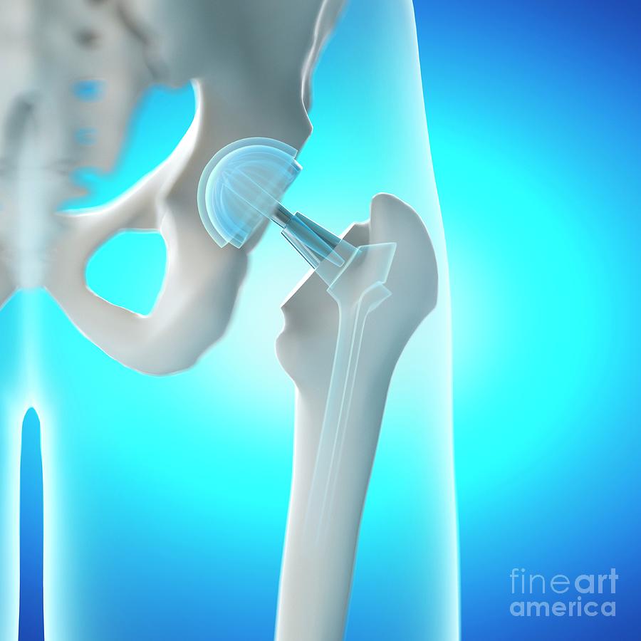 Hip Replacement Photograph By Sebastian Kaulitzki Science Photo Library