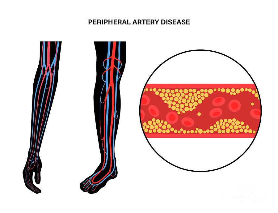 Peripheral Artery Disease Photograph By Pikovit / Science Photo Library ...