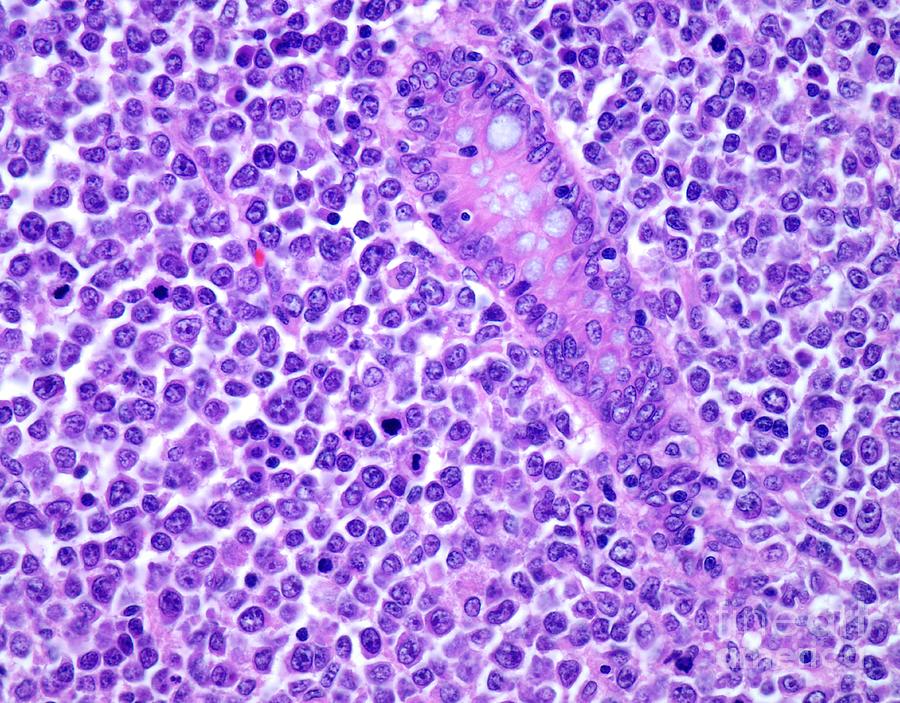 Diffuse Large B Cell Lymphoma Photograph By Webpathologyscience Photo