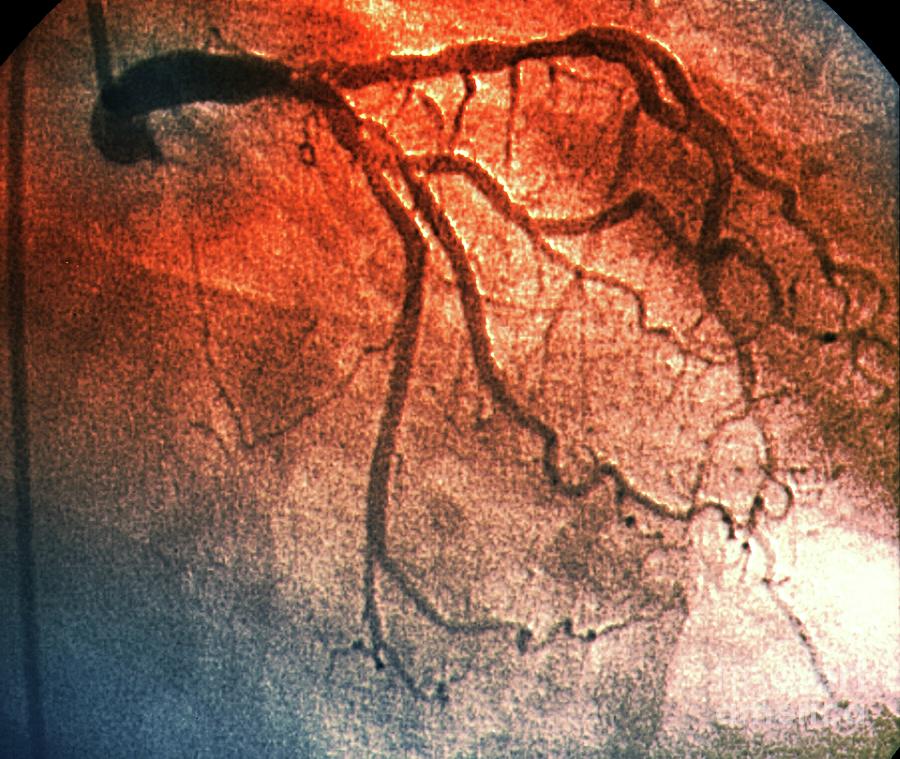 Left Coronary Artery #23 Photograph by Zephyr/science Photo Library