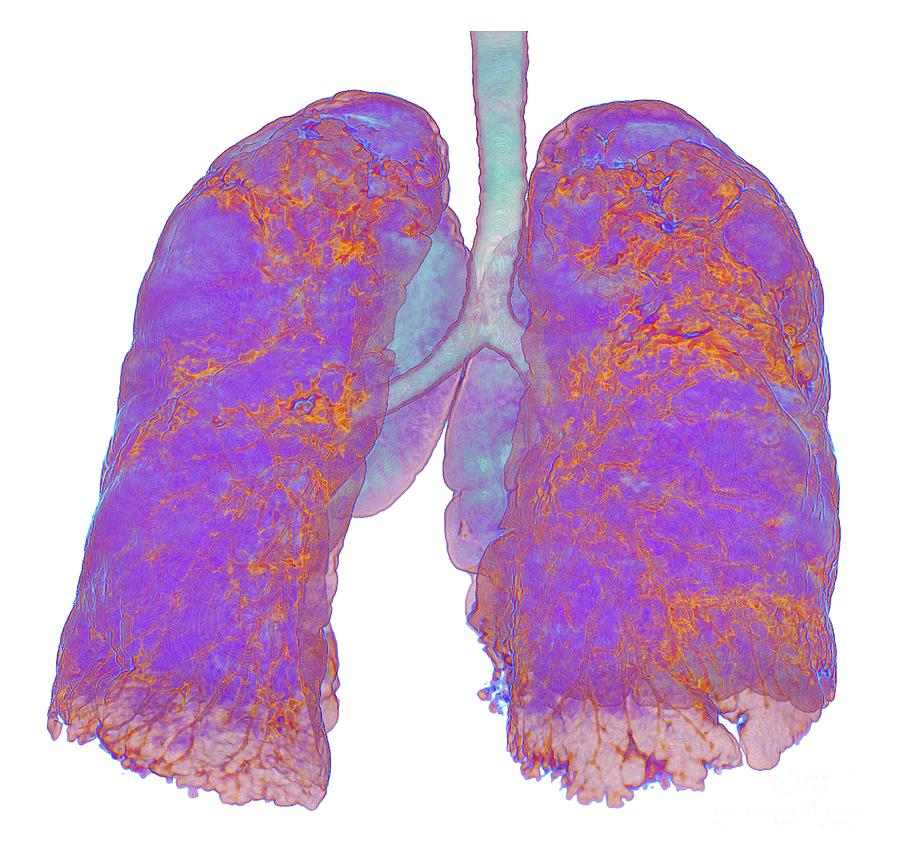 Lungs Affected By Covid-19 Atypical Pneumonia Photograph by K H Fung ...