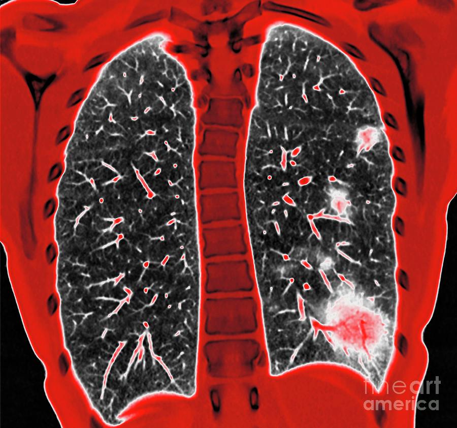 Lungs Affected By Covid-19 Pneumonia Photograph by Vsevolod Zviryk ...