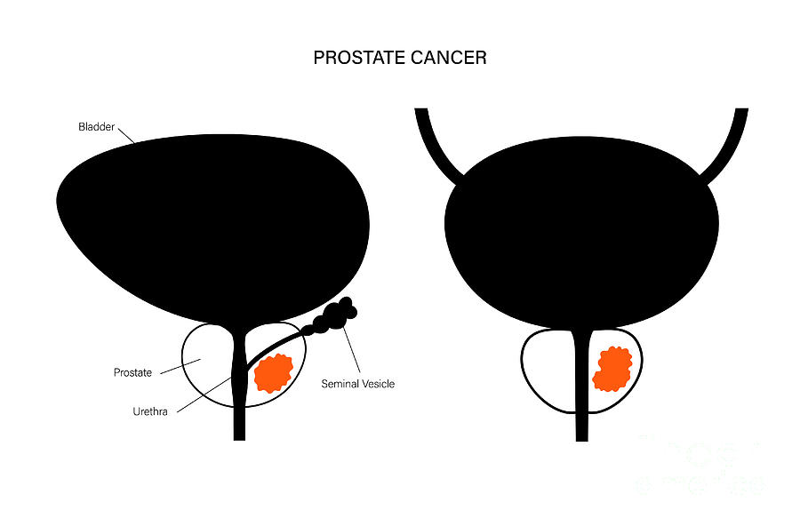 Prostate Cancer Photograph by Pikovit / Science Photo Library - Fine ...