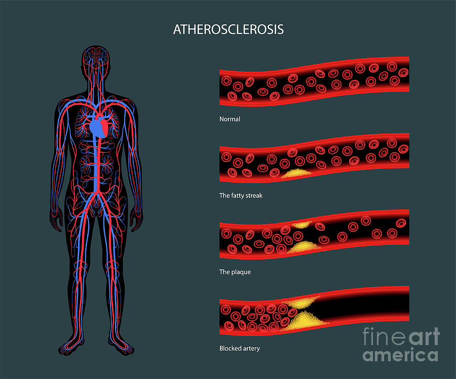 Atherosclerosis Photograph by Pikovit / Science Photo Library - Fine ...