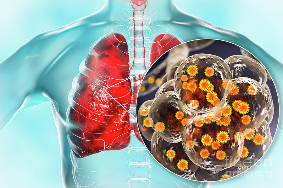 Coronavirus Disease Of The Lungs Photograph by Kateryna Kon/science ...