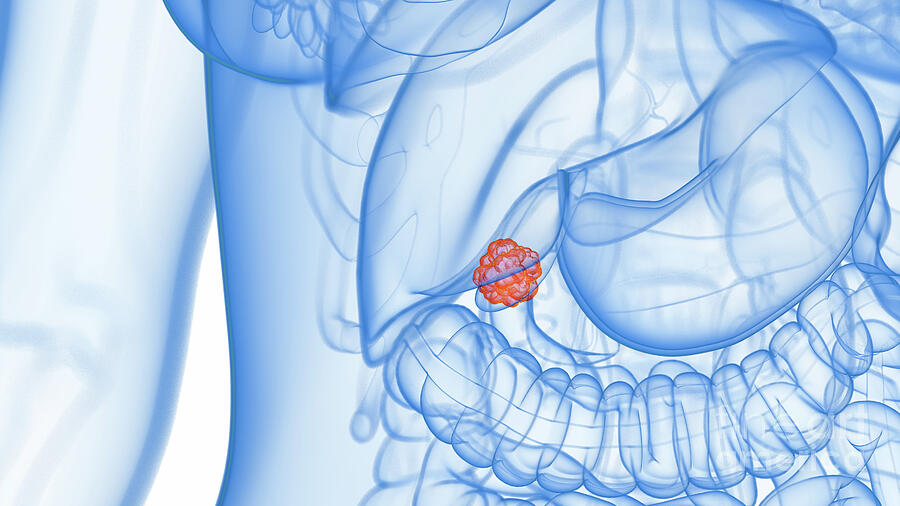 Gallbladder Cancer #24 Photograph by Sebastian Kaulitzki/science Photo Library Gallbladder Cancer #24 Photograph by Sebastian Kaulitzki/science Photo Library