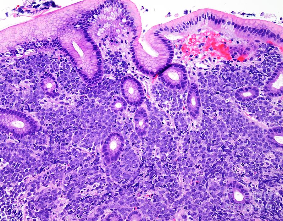 Diffuse Large B-cell Lymphoma Photograph By Webpathology/science Photo ...