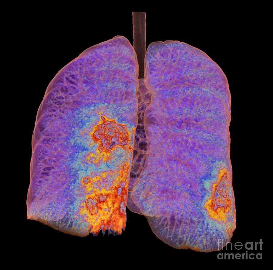 Lungs Affected By Covid-19 Atypical Pneumonia Photograph by K H Fung ...