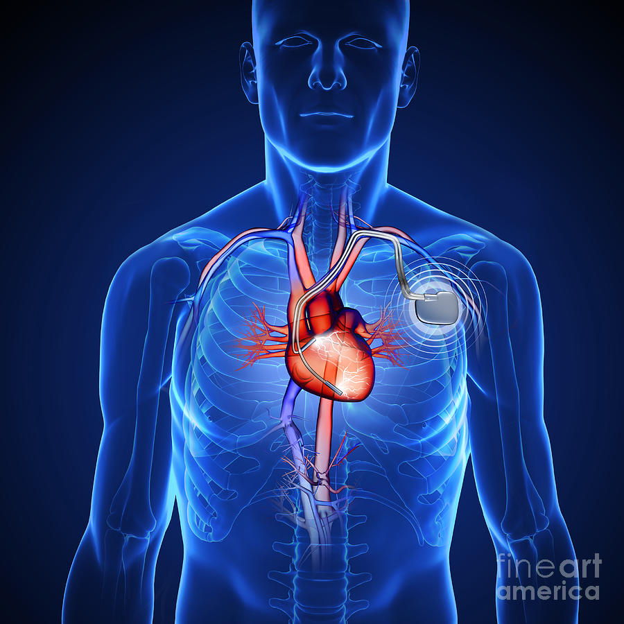 Pacemaker Photograph by Fernando Da Cunha/science Photo Library | Pixels