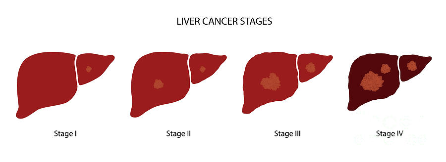 Liver Disease Photograph by Pikovit / Science Photo Library - Fine Art ...