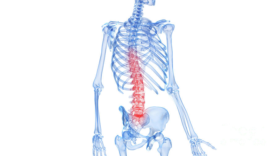 Painful Spine #27 Photograph by Sebastian Kaulitzki/science Photo Library
