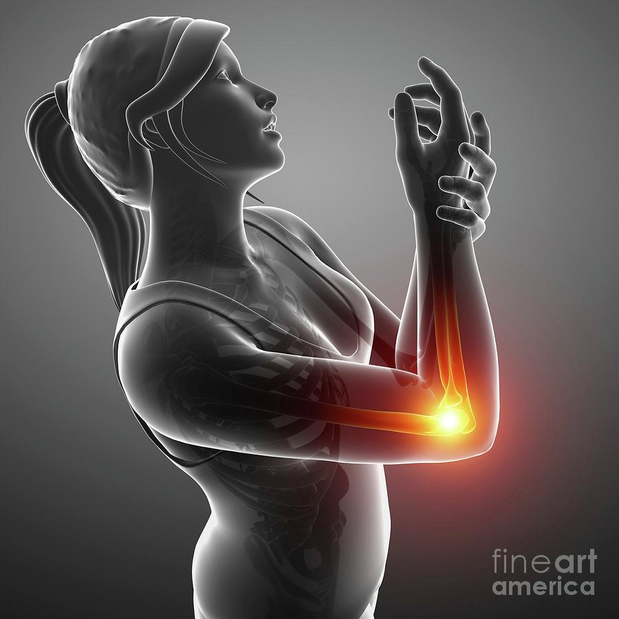 Elbow Photograph - Woman With Elbow Pain #27 by Pixologicstudio/science Photo Library