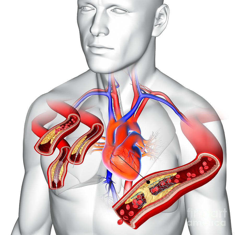 Angioplasty With Stent Placement Photograph by Fernando Da Cunha ...