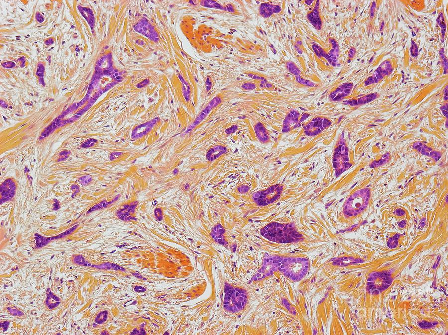 Breast Cancer #28 Photograph by Steve Gschmeissner/science Photo Library