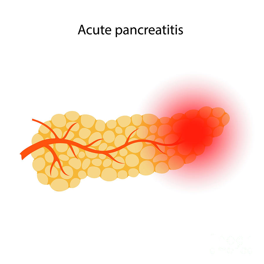 Acute Pancreatitis #3 Photograph by Pikovit / Science Photo Library