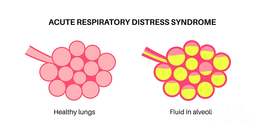 Acute Respiratory Distress #3 Photograph by Pikovit / Science Photo Library Acute Respiratory Distress #3 Photograph by Pikovit / Science Photo Library