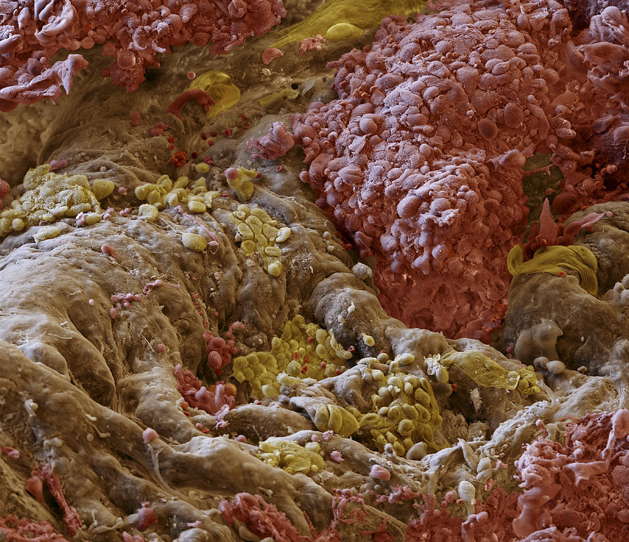 Adenocarcinoma Of The Lung, Sem Photograph by Meckes/ottawa