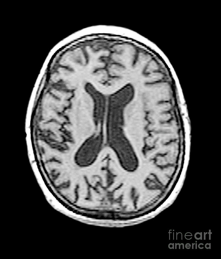 Alzheimers Disease Mri #3 Photograph by Dr W. Crum, Dementia Research Group, Tim Beddow/science Photo Library